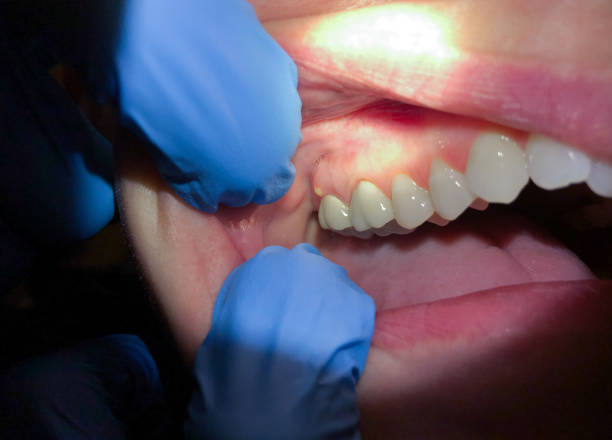 Best Emergency Tooth Extraction in Ben Bolt, TX